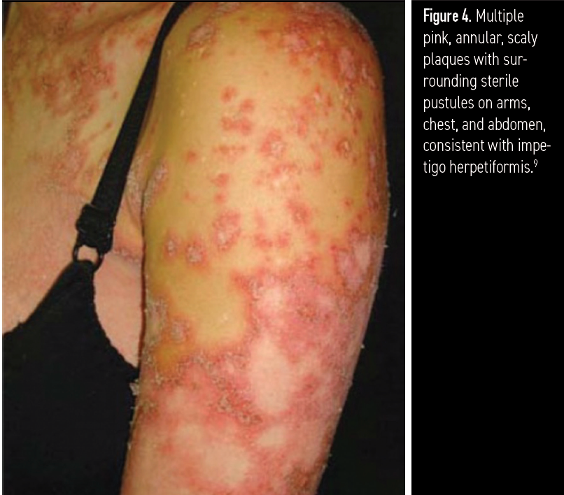 Figure 4. Multiple pink, annular, scaly plaques with surrounding sterile pustules on arms, chest, and abdomen, consistent with impetigo herpetiformis.9